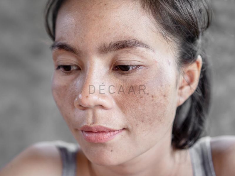 cách điều trị nám mảng